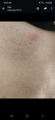 Insect bite