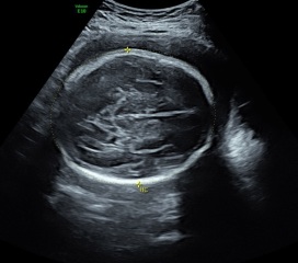 Hydrocephalus? - anyone good with scans