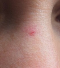 Red patch on nose