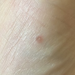 Weird lesion on thumb joint - any idea what it is? Pic included