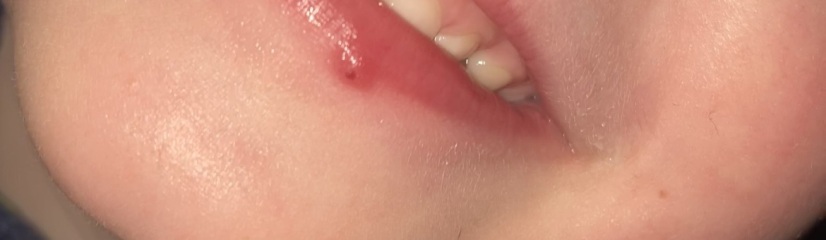 Spot or cold sore?