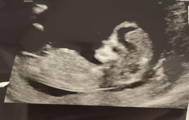 Can anyone guess the gender of our baby using the nub theory?