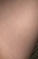 Non blanching rash