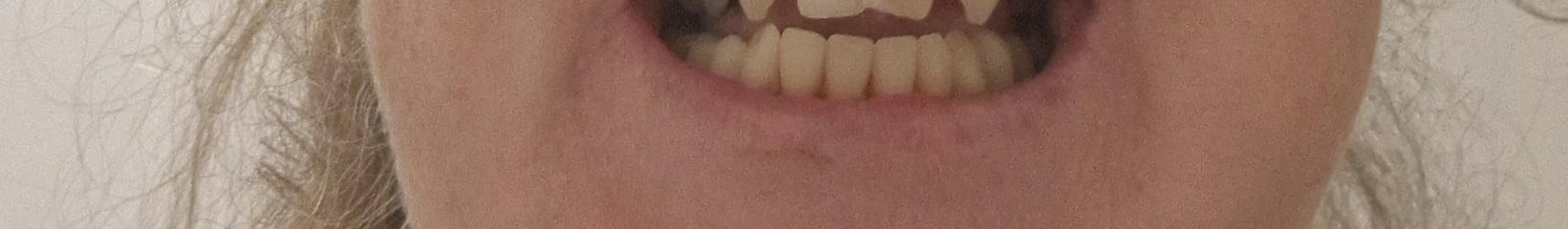 Can you tell theses are dentures