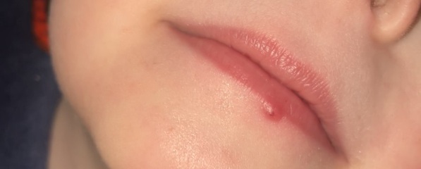 Spot or cold sore?