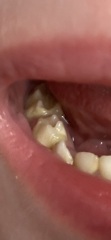 Toddler teeth concern - could this be decay?