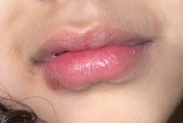 Cold sore or dry skin