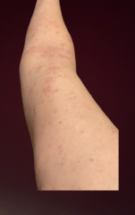 Scabies