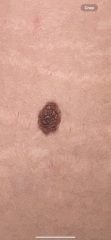 Do these moles look normal?