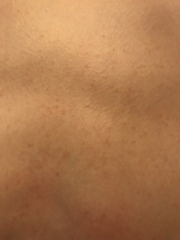 Measles or reaction to HPV vaccine?