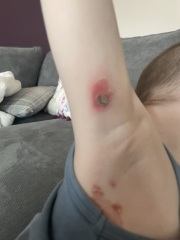 Skin infection HELP