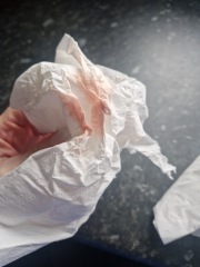 Implantation Bleeding