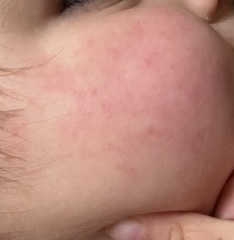 Is this what slapped cheek looks like?