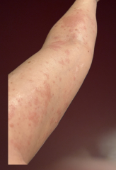 Scabies