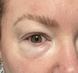Guess the eye issue?