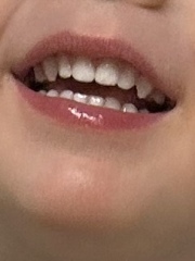 Is this a severe lip tie ? Worried mum