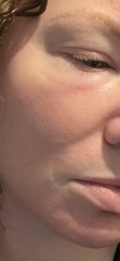 Guess the eye issue?