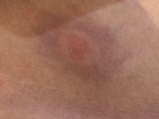 Reaction to an insect bite