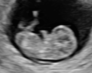Is this nuchal translucency or amnion? Any sonographers out there..? 🙏