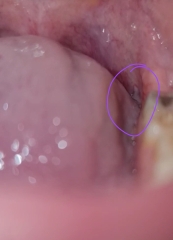 Is that Leukoplakia?