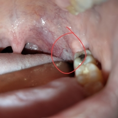 Is that Leukoplakia?