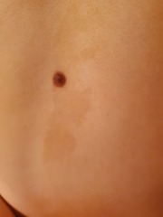 Child's mole