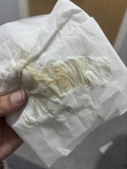 Is this thrush? Should I be worried TMI pics