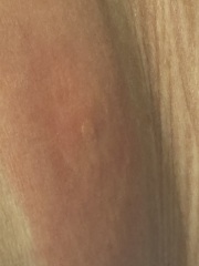 Reaction to an insect bite