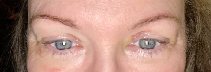 Anyone had upper eyelid surgery?