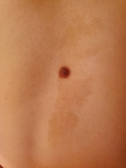 Child's mole