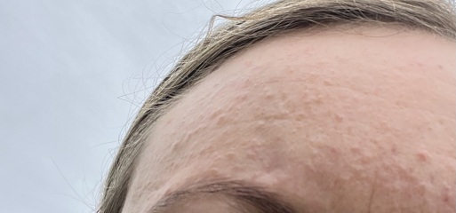 Skincare help! Small bumps over forehead etc