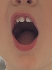 Is this a severe lip tie ? Worried mum