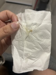 Is this thrush? Should I be worried TMI pics