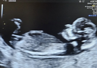 Nub theory is it a BOY💙 or GIRL🩷?