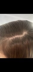 Hair loss..