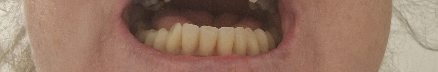 Can you tell theses are dentures