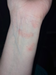 Hand eczema, losing the will!