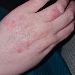 Hand eczema, losing the will!