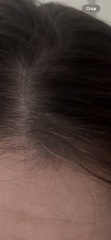 Hair loss..