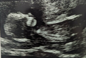 Girl or boy?