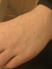 Measles or reaction to HPV vaccine?