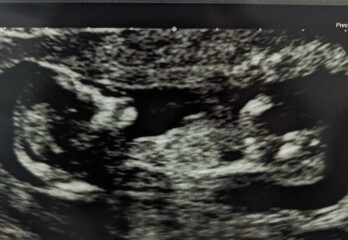 Girl or boy?
