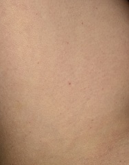 Non blanching rash