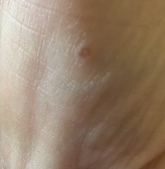 Weird lesion on thumb joint - any idea what it is? Pic included