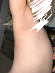 Allergy toddler