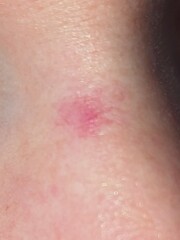 Red patch on nose
