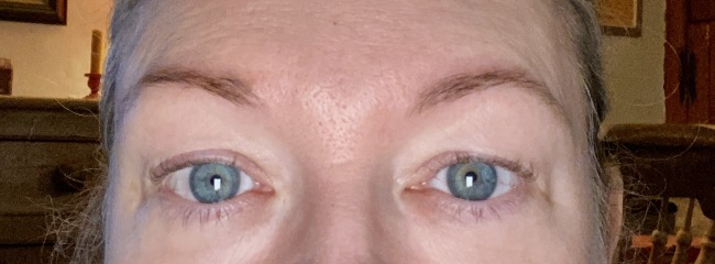 Anyone had upper eyelid surgery?
