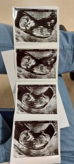 12.5 week ultrasound nub theory ??