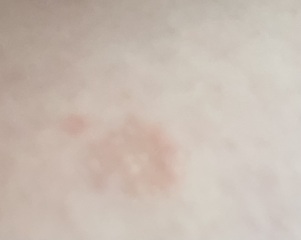 Is this shingles?