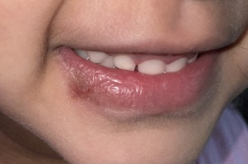 Cold sore or dry skin